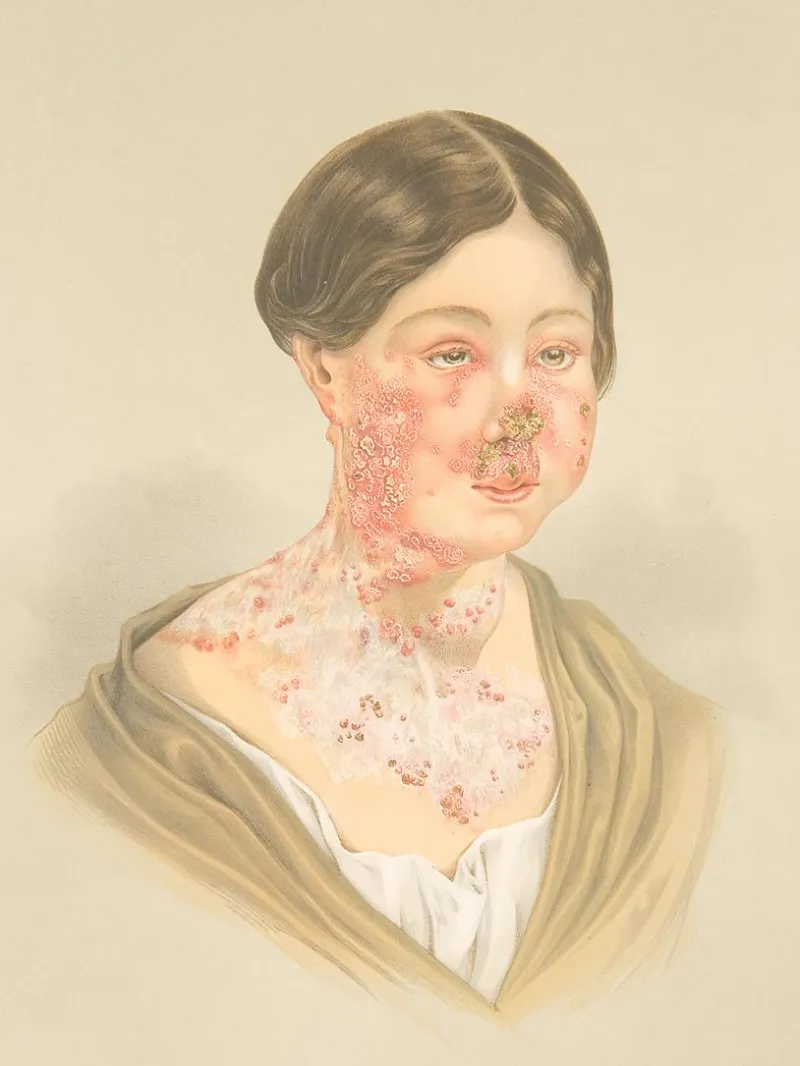 From Flare-Ups to Freedom: How Hydroxychloroquine Is Reshaping Daily Life for Lupus and RA Patients